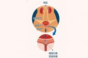 漏尿怎么办
