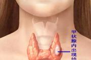 警惕甲状腺结节的8大危害，很要命！
