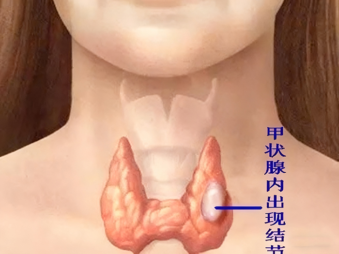 甲状腺结节的危害不可忽视